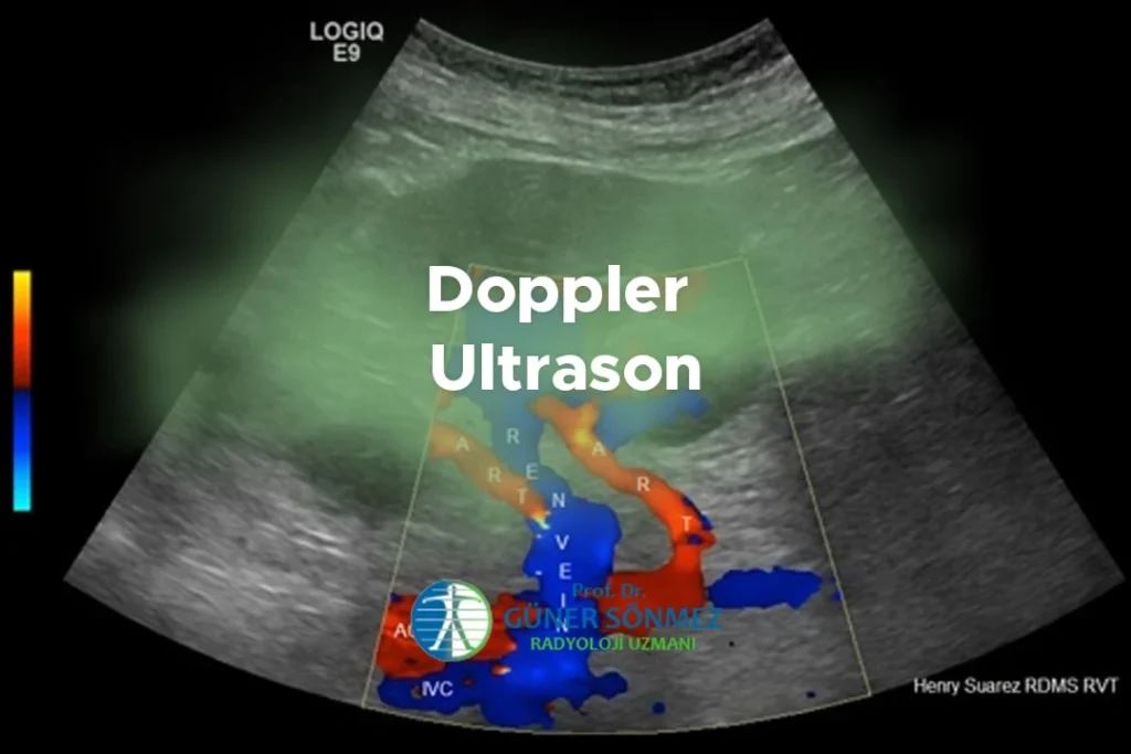 Doppler Ultrason