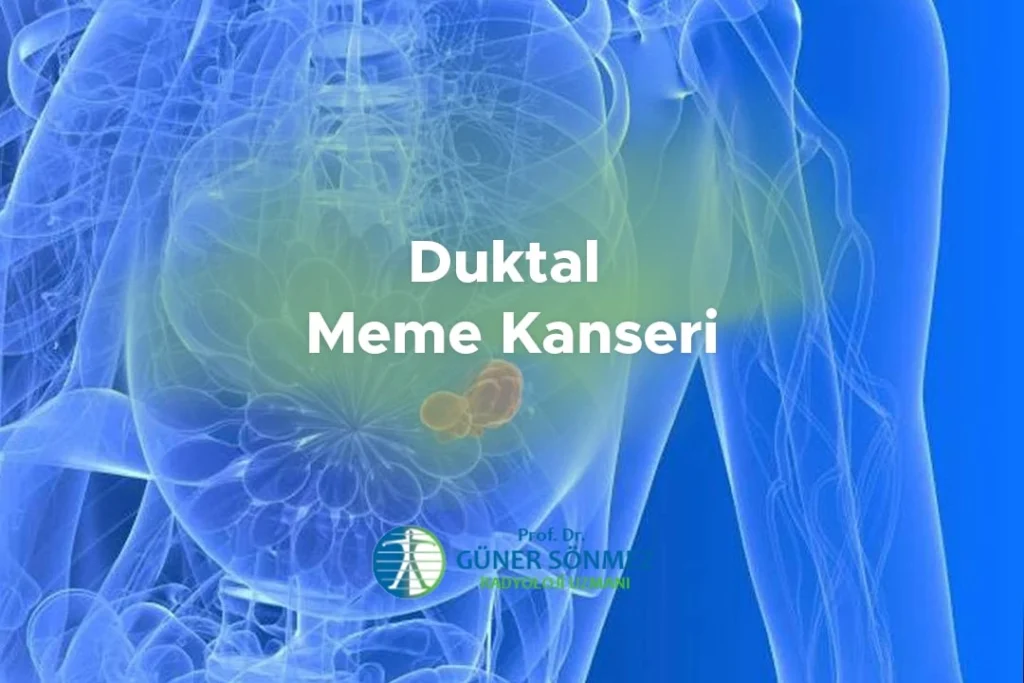 Duktal Meme Kanseri
