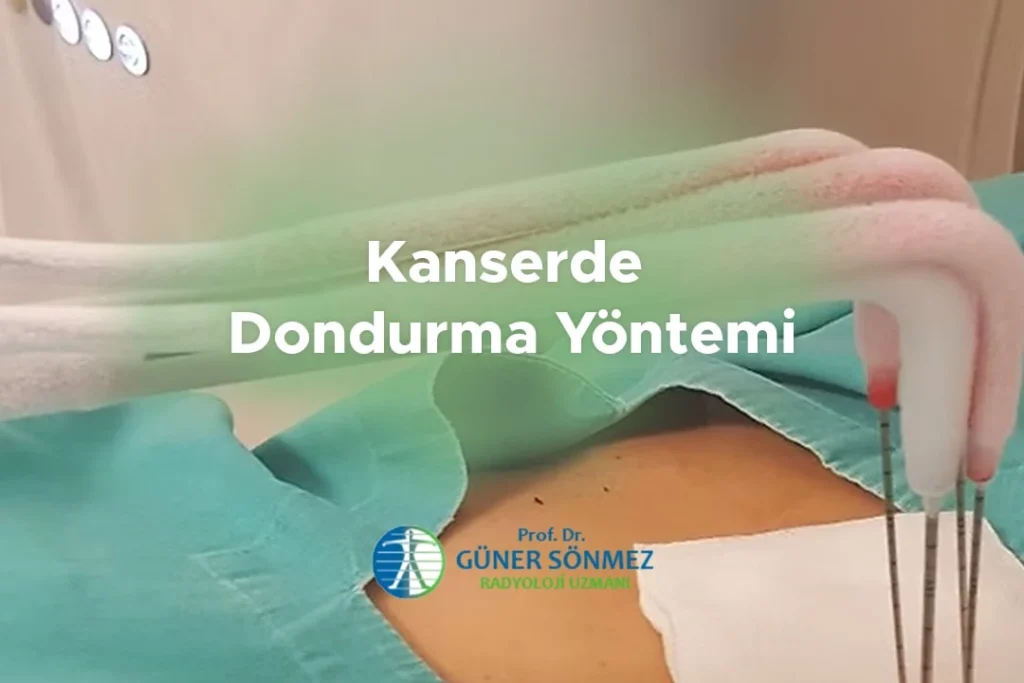 Kanserde Dondurma Yöntemi
