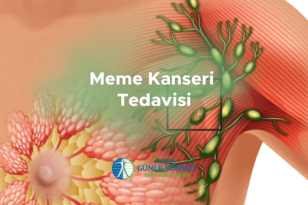 Meme Kanseri Tedavisi