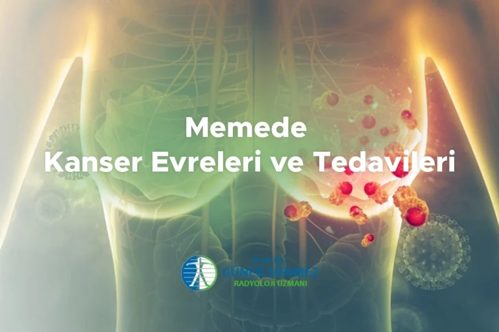 Memede Kanser Evreleri ve Tedavileri