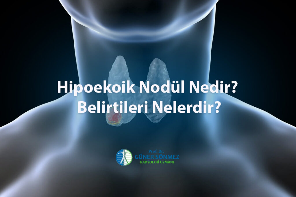 Hipoekoik Nodül Nedir Belirtileri Nelerdir