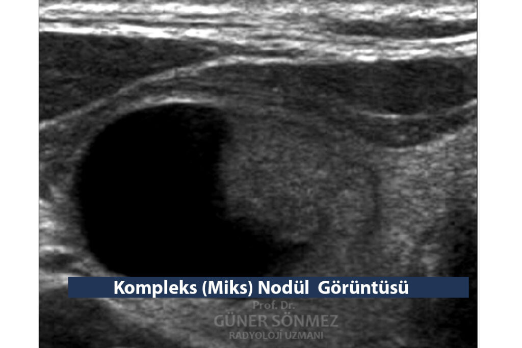 Kompleks (Miks) Nodül