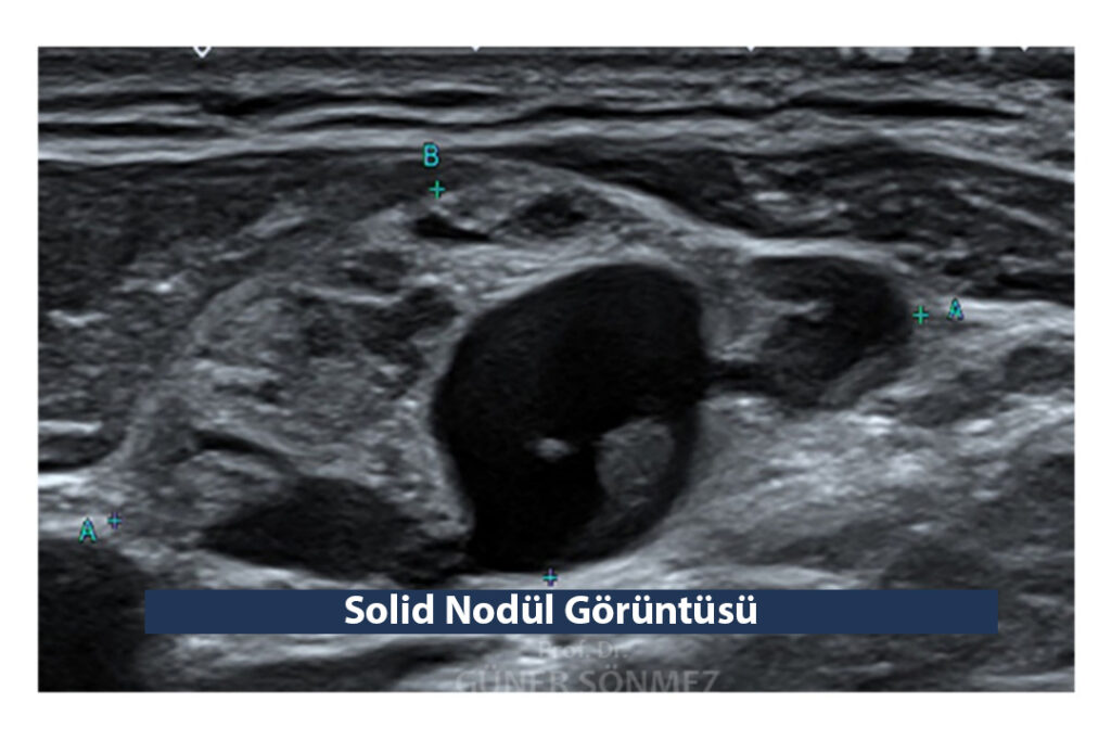 Solid Nodül 