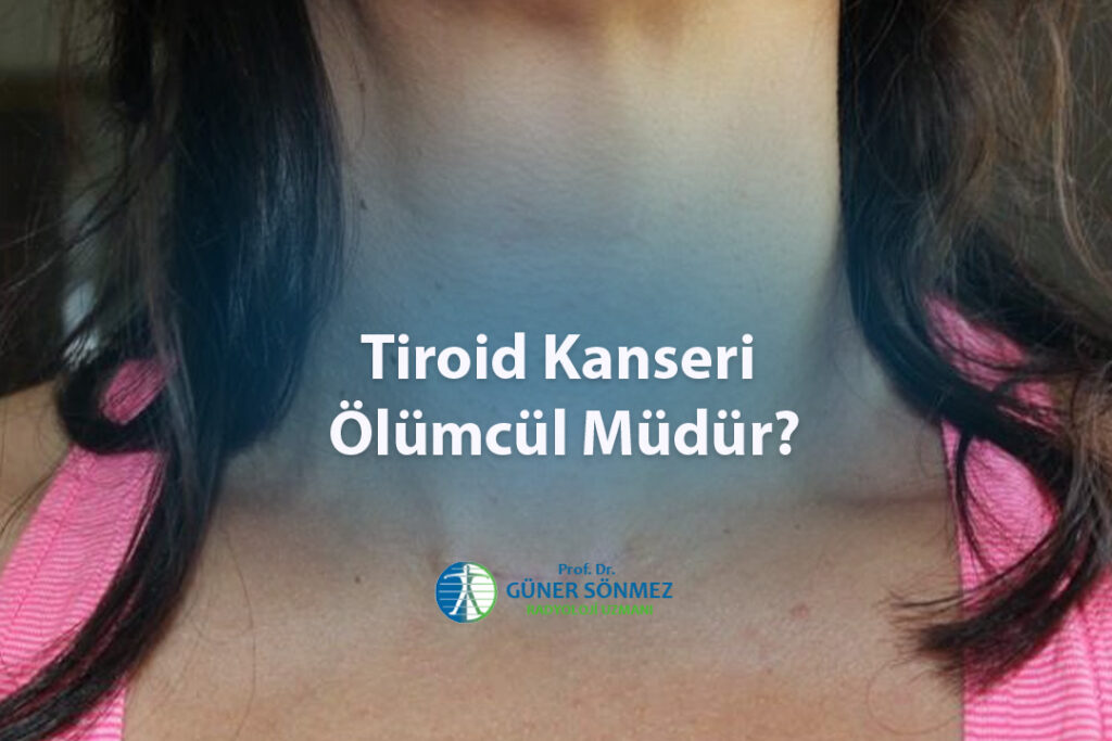 Tiroid Kanseri Ölümcül Müdür