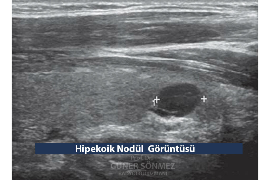 Ultrasonda görülen hipekoik nodül görüntüsü