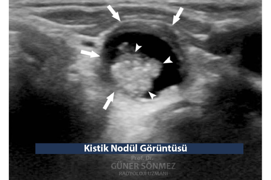 kistik nodul
