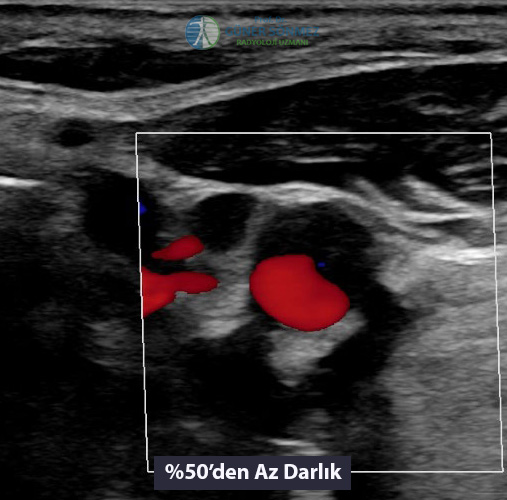 Vertebral Arter Renkli Doppler US Görüntüsü 2