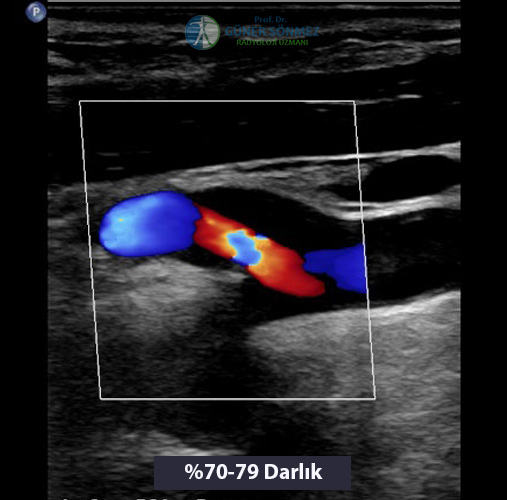Vertebral Arter Renkli Doppler US Görüntüsü 4