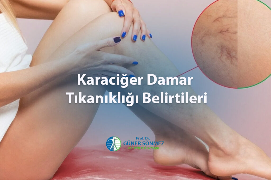 Karaciğer Damar Tıkanıklığı Belirtileri