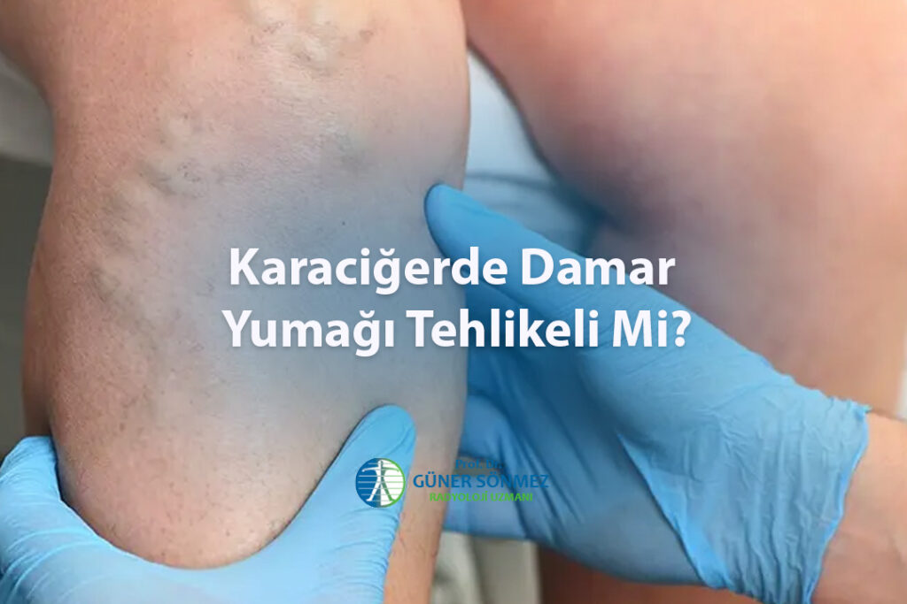 Karaciğerde Damar Yumağı Tehlikeli Mi