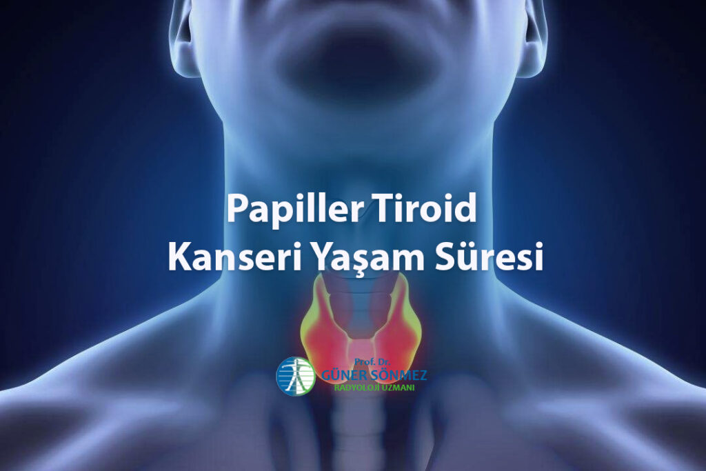 Papiller Tiroid Kanseri Yaşam Süresi
