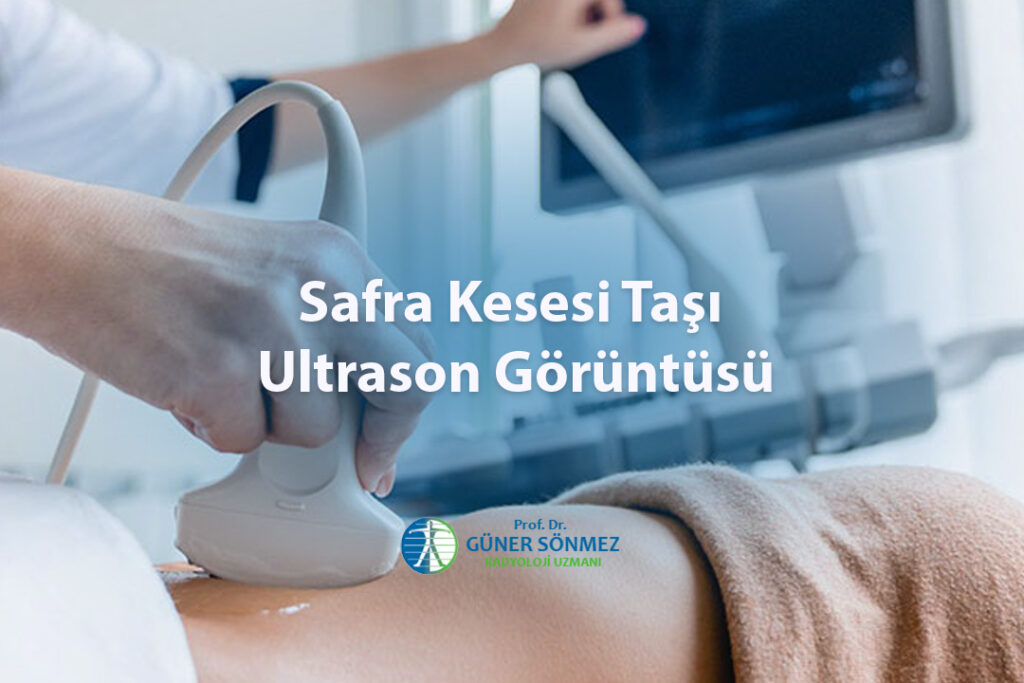 Safra Kesesi Taşı Ultrason Görüntüsü