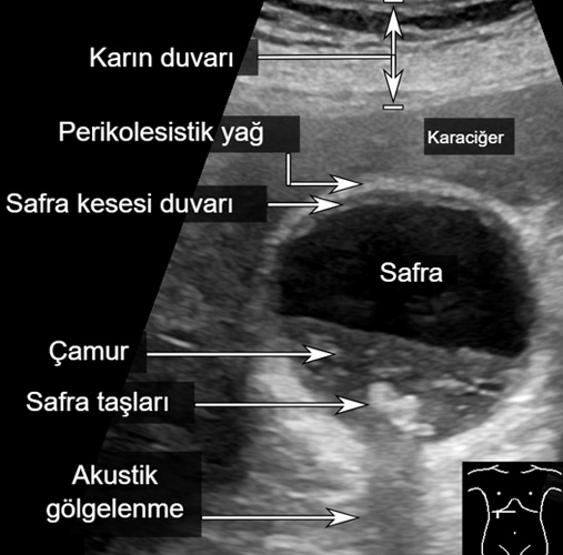 Safra Kesesi Taşı Ultrason Görüntüsü