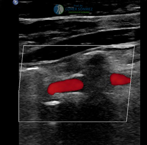 Vertebral Arter Renkli Doppler US Görüntüsü 3